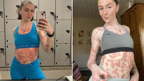 «Από έναν απλό πονόλαιμο κατέληξα με σπάνια μορφή ψωρίασης σε όλο μου το σώμα»